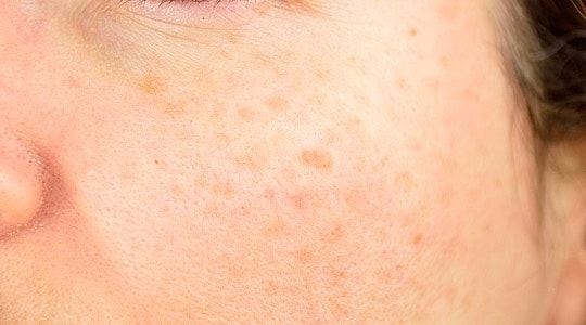 Close-up of skin with uneven texture and spots.