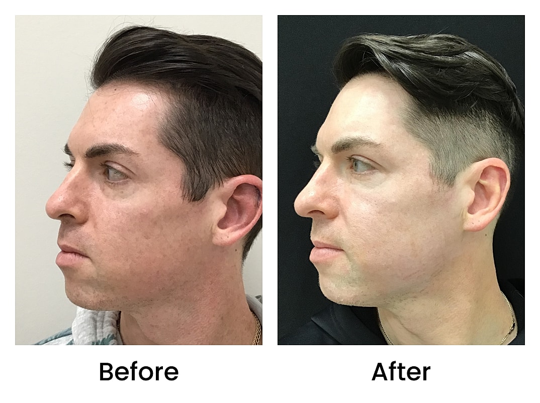 Bbl Laser Men Before & After