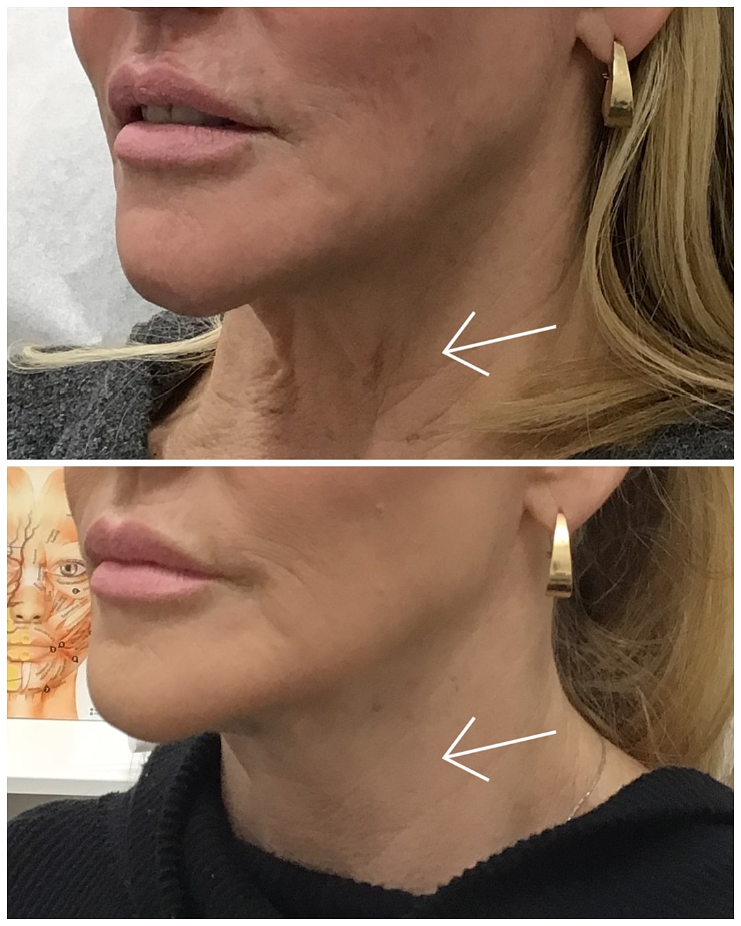 Comparison of neck skin texture before and after.