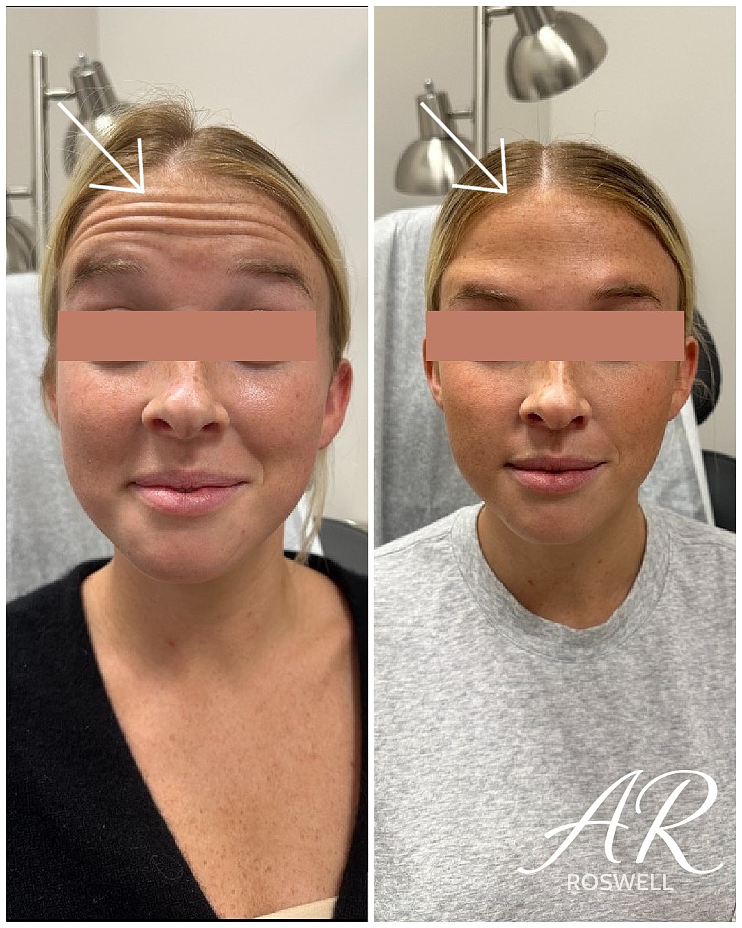 Botox Before & After