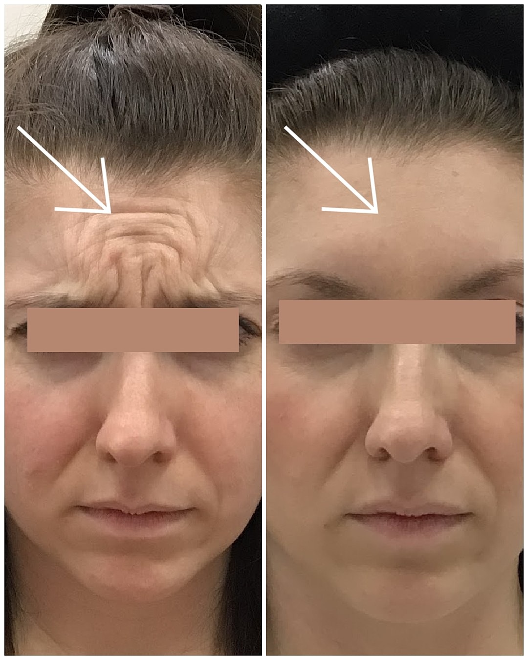 Botox Before & After