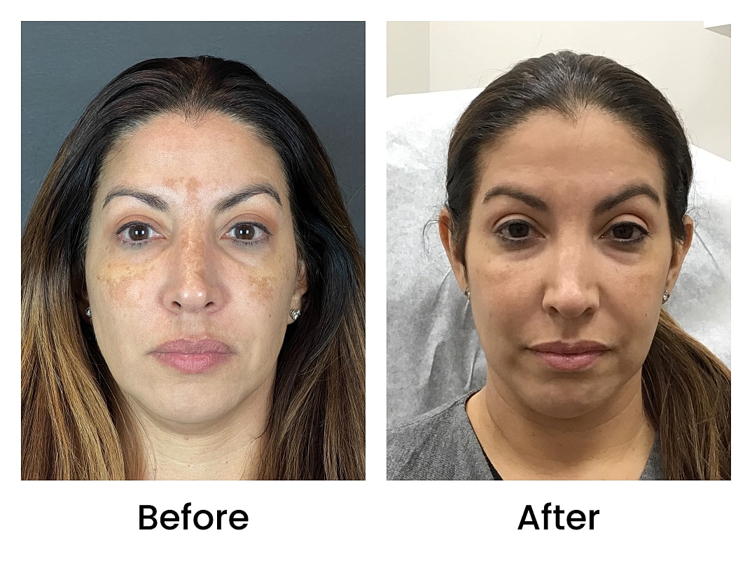 Moxi Laser Before & After