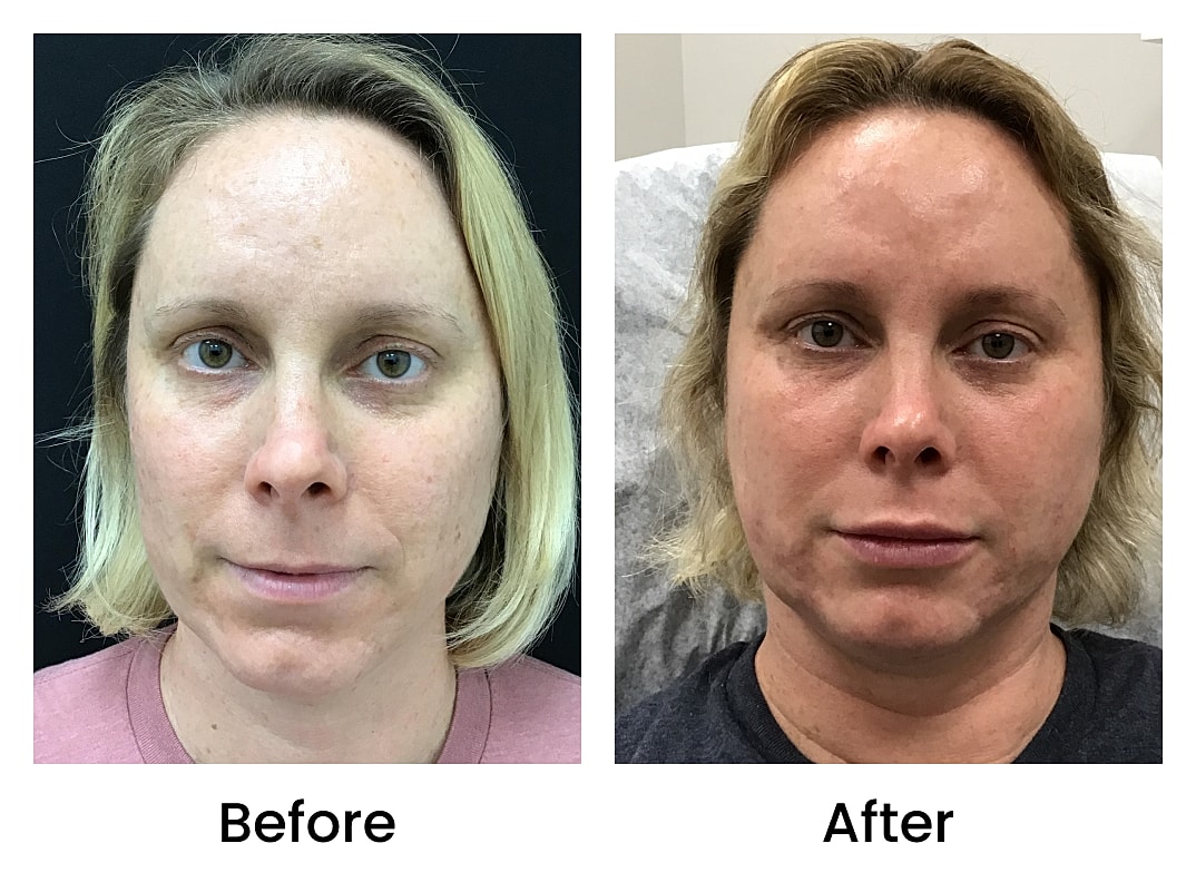 Dermal Fillers Before & After