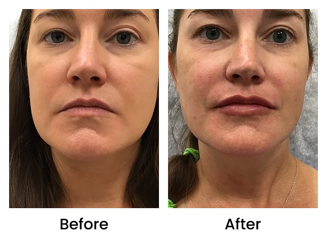 Dermal Fillers Before & After