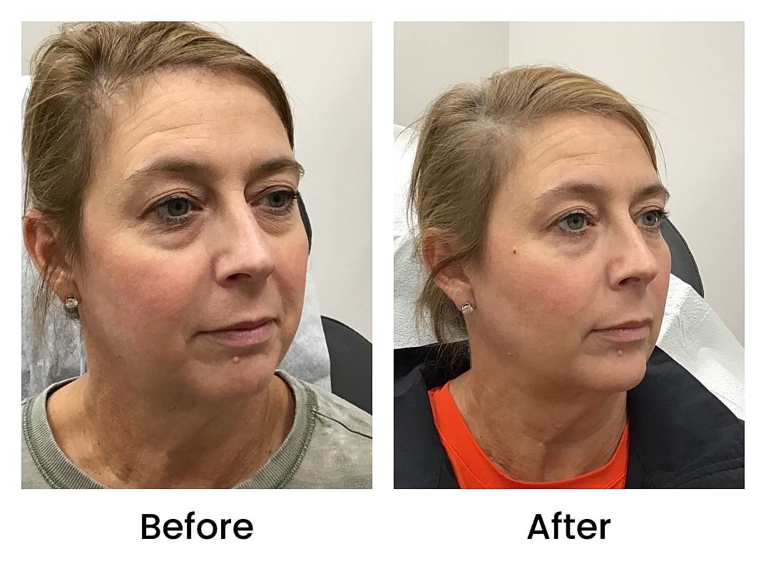Dermal Fillers Before & After