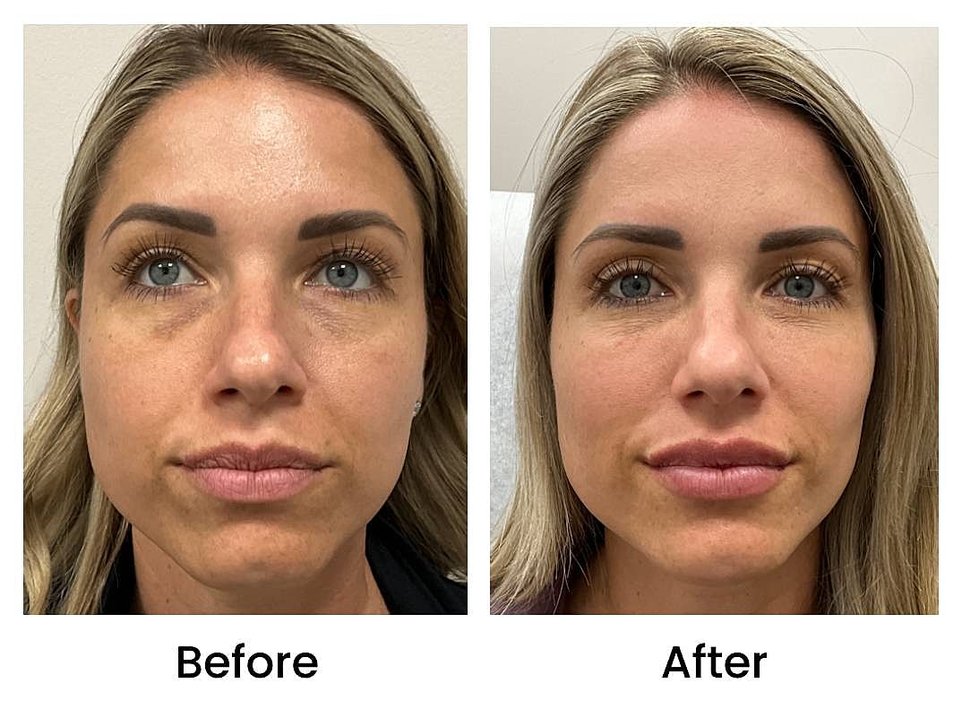 Dermal Fillers Before & After