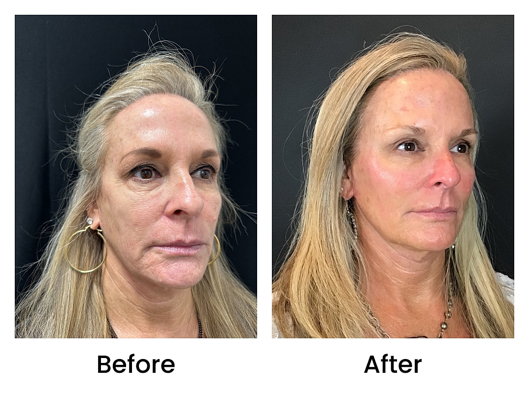 Rf Microneedling Before & After