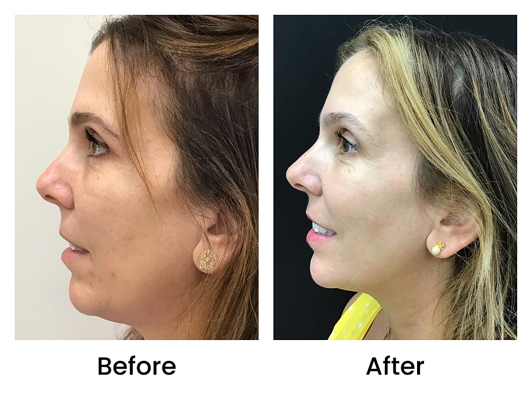 Hydrafacial Before & After