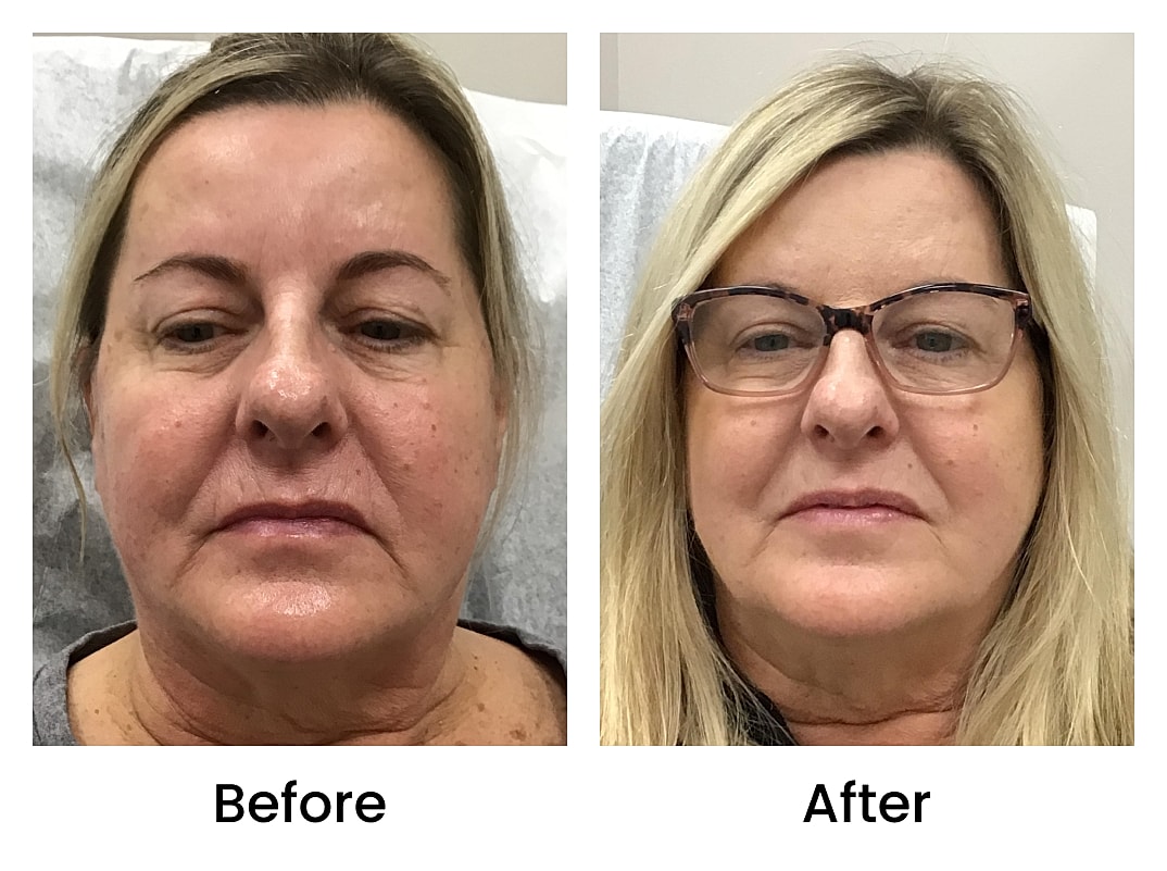 SKINVIVE  Before & After