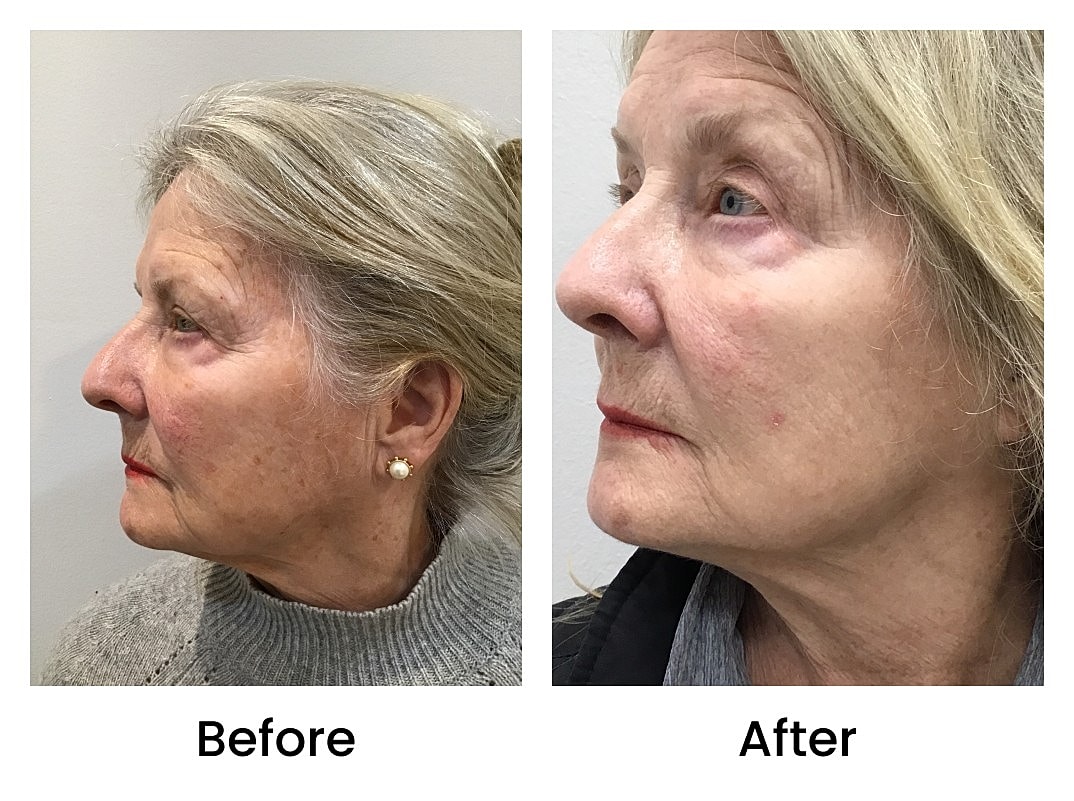 Bbl Laser Before & After