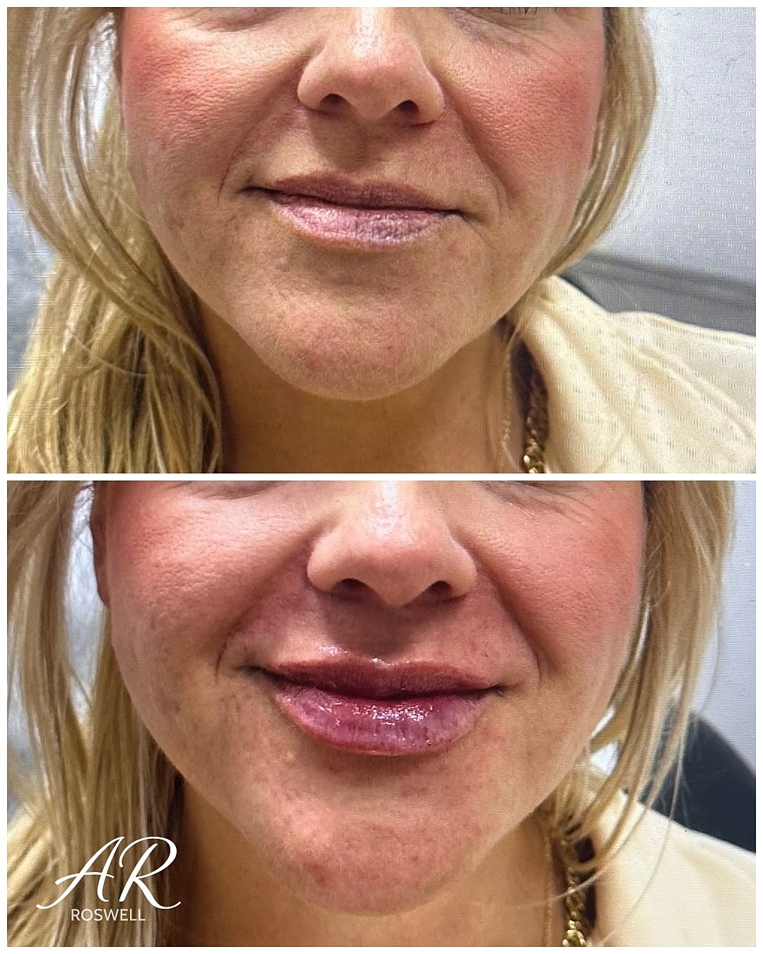 Lip Fillers Before & After