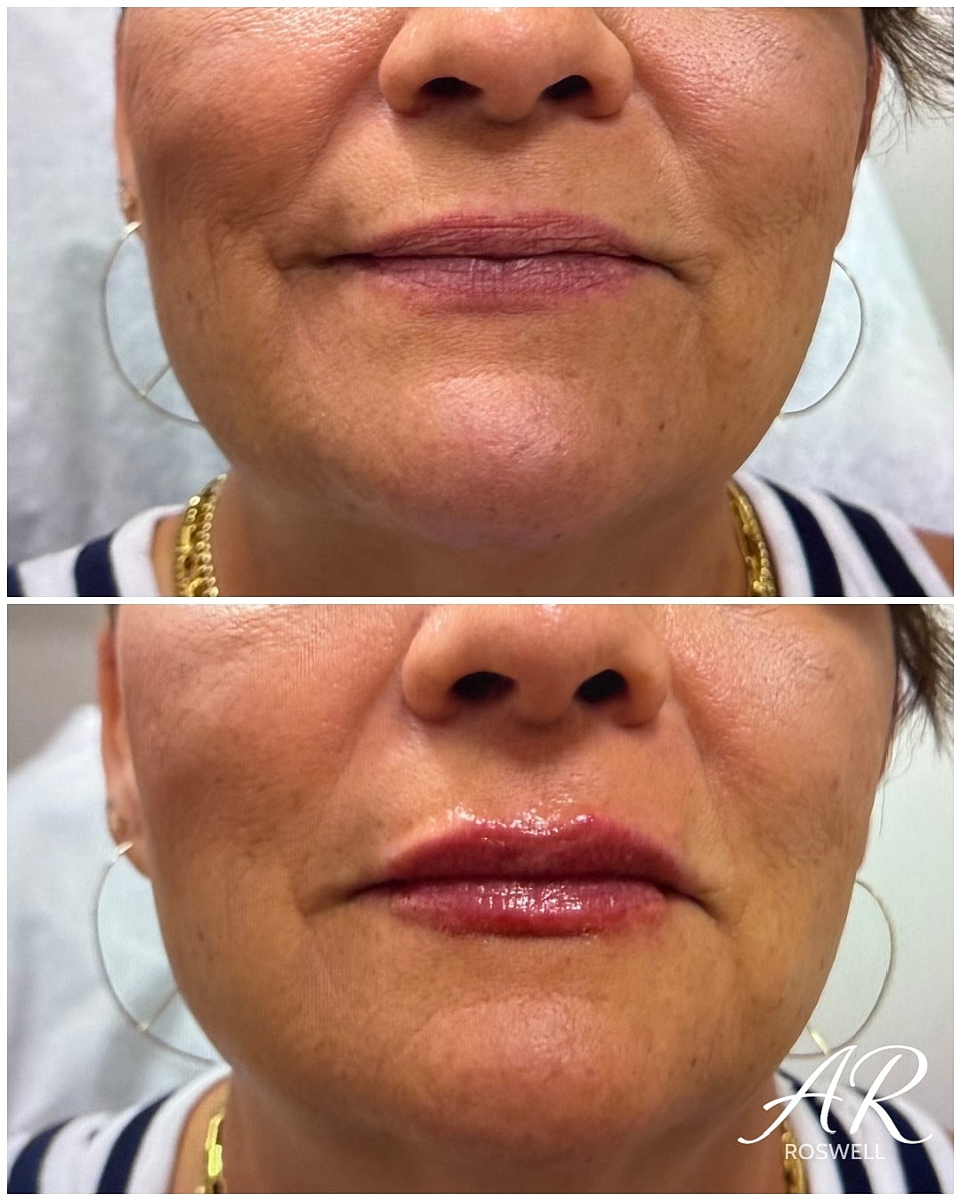 Lip Fillers Before & After