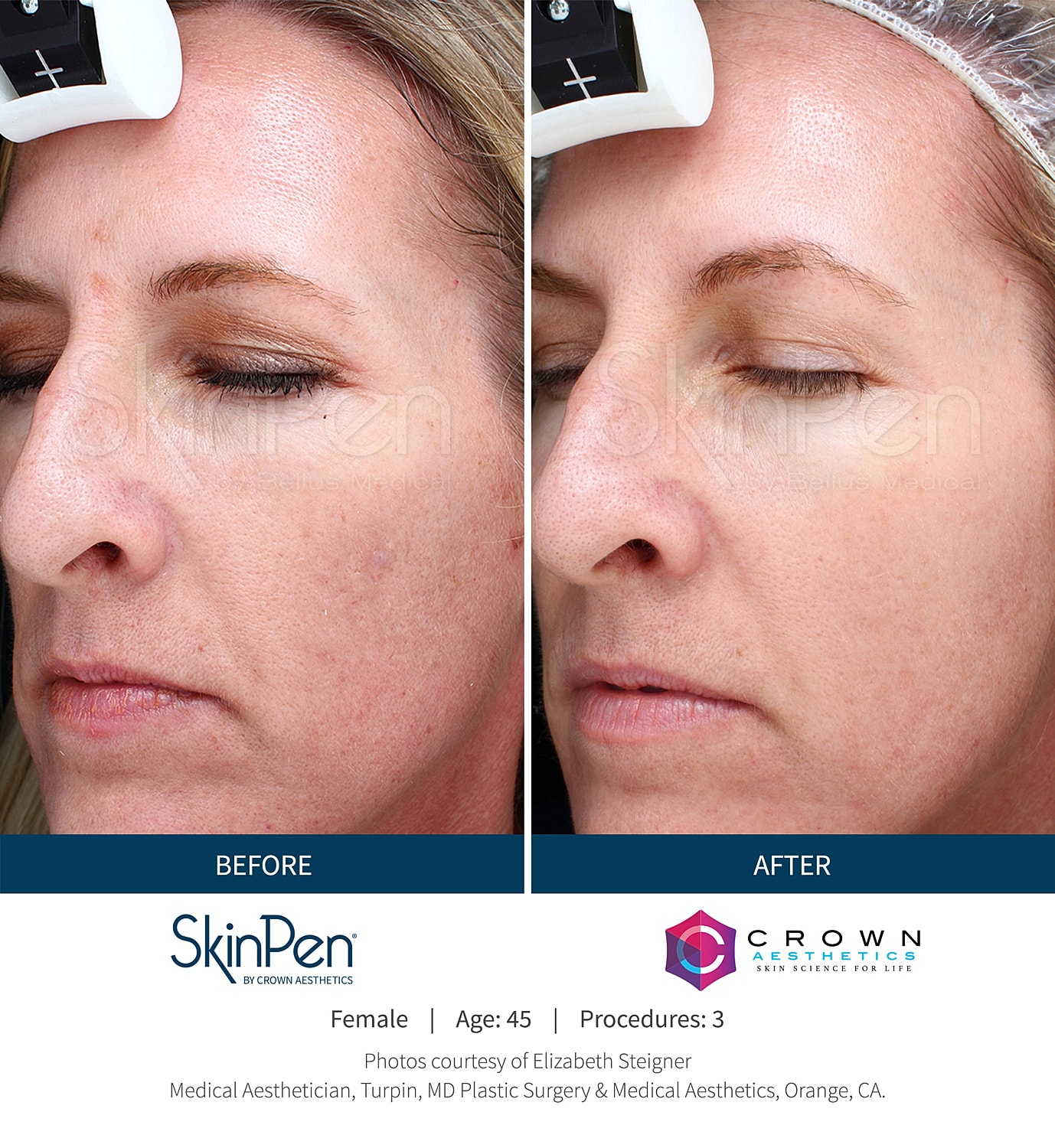 SkinPen treatment results: before and after images.