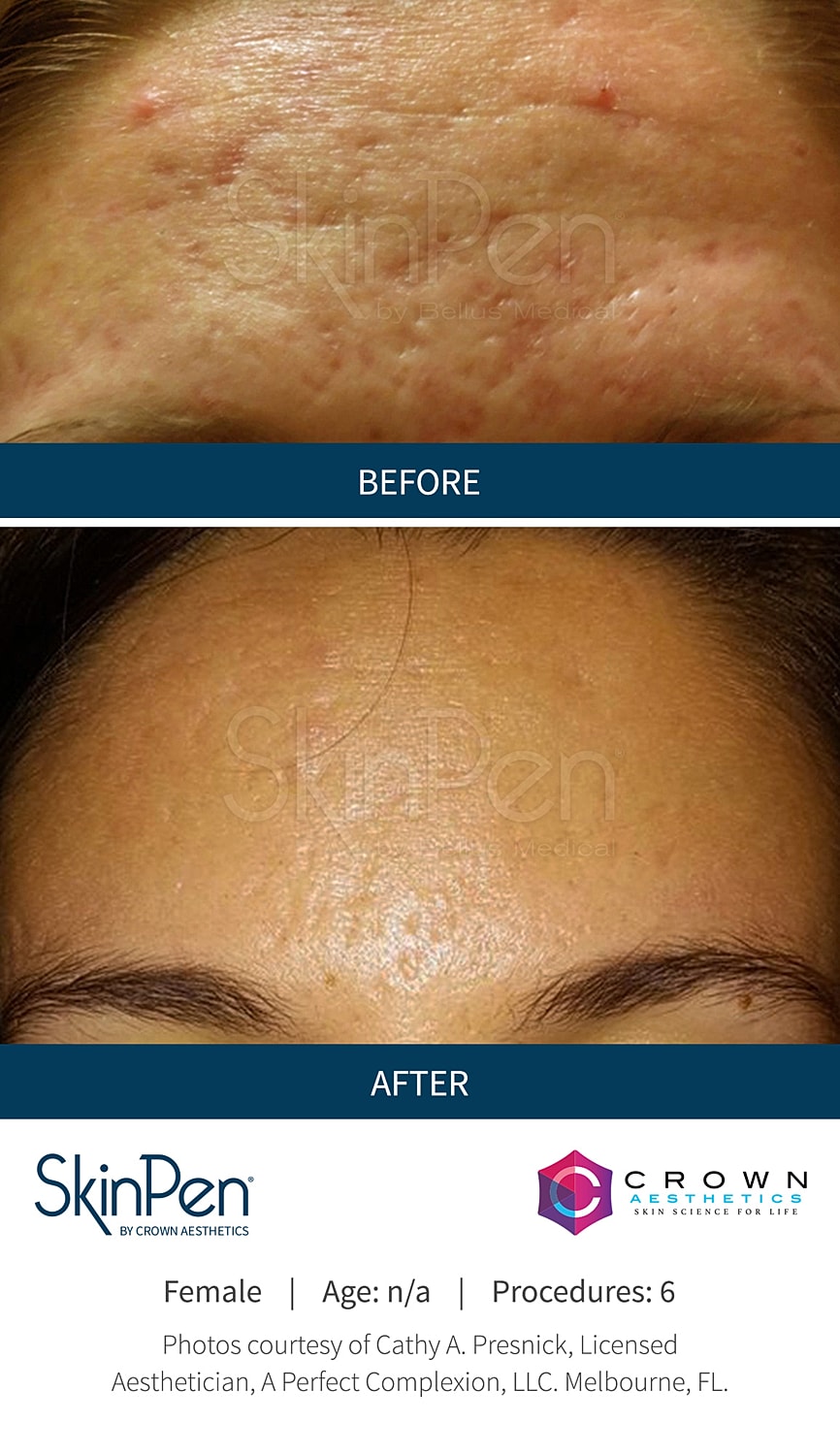 Skin rejuvenation results: before and after treatment.