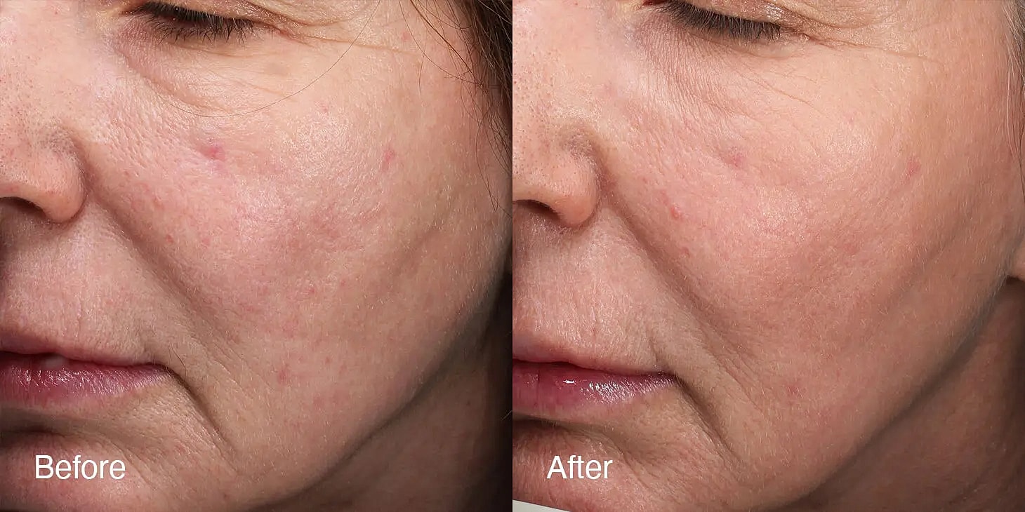 Skin improvement before and after treatment.