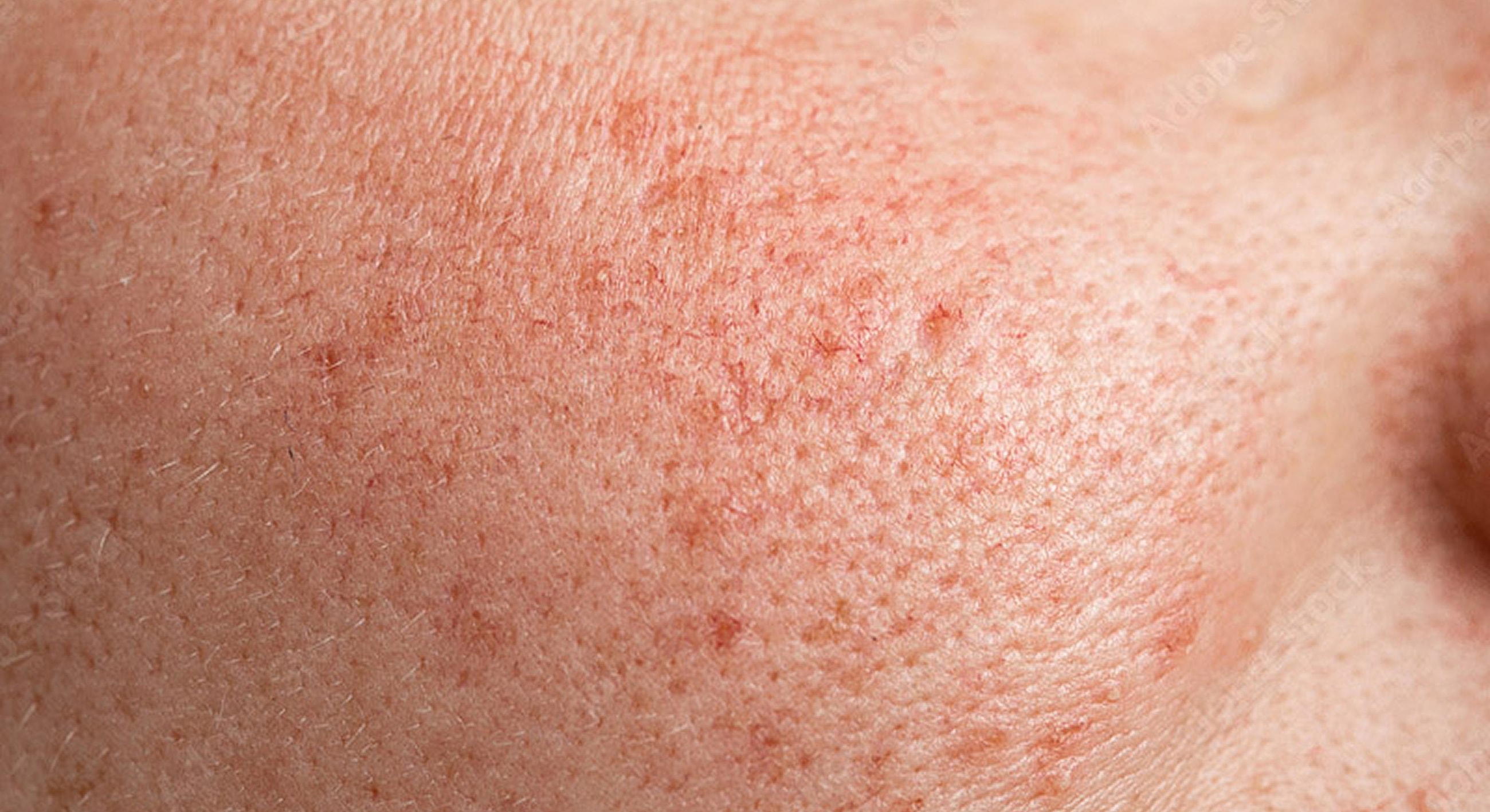 Close-up of textured facial skin surface.