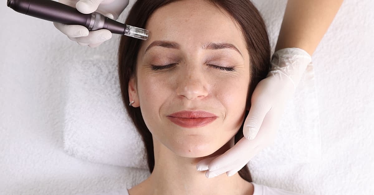 Microneedling vs Chemical Peels: Which Treatment Fits Your Skin Goals? 