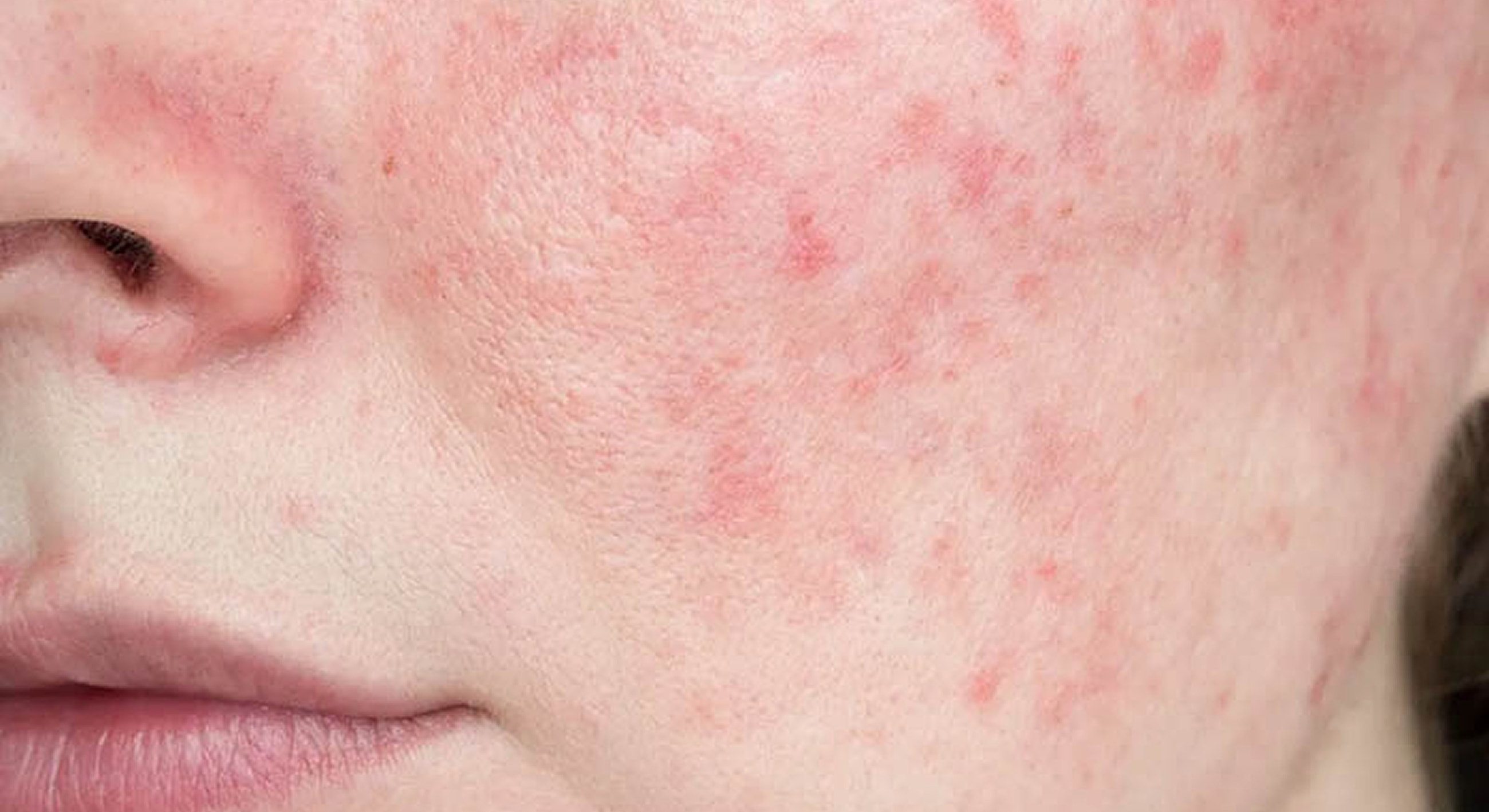 Close-up of skin with redness and blemishes.