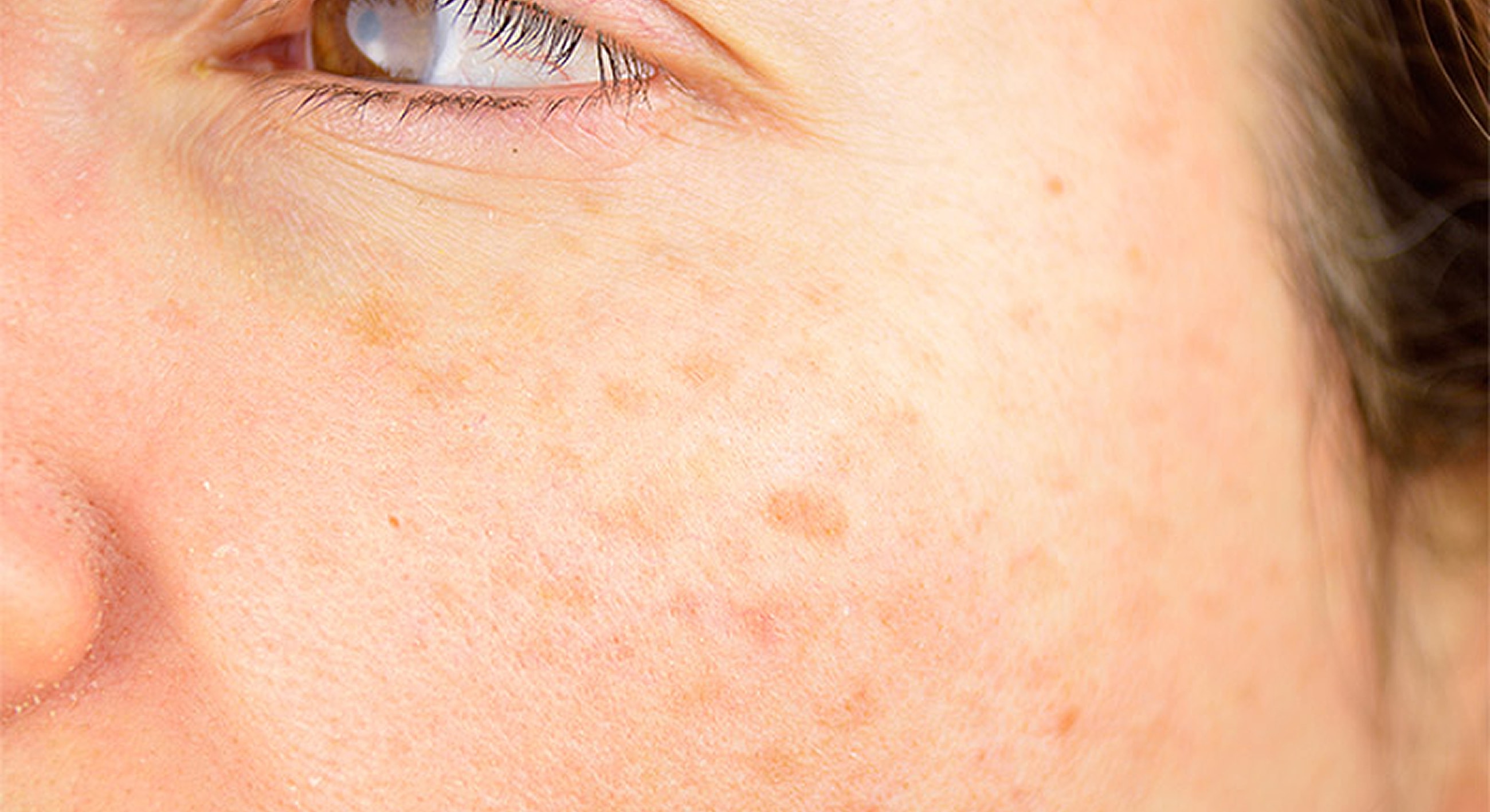 Close-up of skin with brown spots.