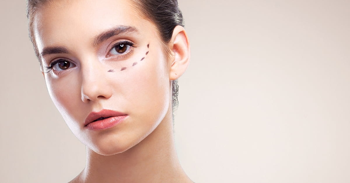  Does Dermal Filler Work for Dark Circles?